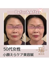 瑞 鍼灸院/えら・食い縛りケア５０代美容鍼