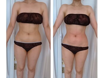 ムーンブロッサム(MoonBlossom)/脂肪撃退痩身120分上半身