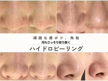 ＜ハイドロピーリング×肌悩み別アンプル＞徹底した肌管理◎