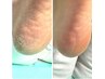 【かかとケア】踵の角質フットケア！価格◎￥5500美容成分配合スクラブ使用