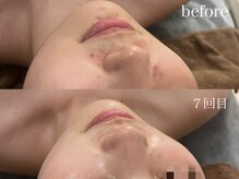 サロンワイアネシス(Salon y ANESIS)/ハーブピーリング　7回の変化