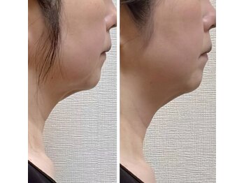 ル フラーズ(Les Fleurs)/横顔のたるみ