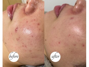 ルーム(lume)の写真/【美肌ケア◎】一度施術したら病みつきに！ハーブピーリングで透明感のある肌へ★完全個室でゆったり施術♪