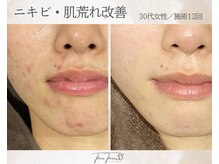 スリースリー 恵比寿(THREE THREE)/ニキビ・肌荒れケア