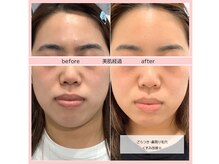 ディアメ(Diame)/毛穴洗浄はお任せください！！！
