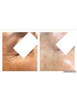 オアジスパ(Oasi Spa)/ターンオーバーに着目