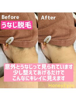 ハニーアイズ(Honey Eyes)/うなじmix脱毛で後ろ姿スッキリ!