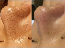 ラトナ(RATNA)の雰囲気（当店だけのオリジナルケアでしっかり毛穴詰まり除去していきます）