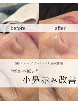 ワイシーハッチ(yc.hacci)/ハーブピーリング