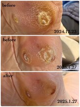 トウキョウビューティーラボ 表参道店(TOKYO BEAUTY LABO.)/深い魚の目も！