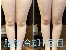 リフュージュ 隠れ家の雰囲気（大人気！結果に繋がるのが早い『脂肪冷却』☆ブライダルにも◎）