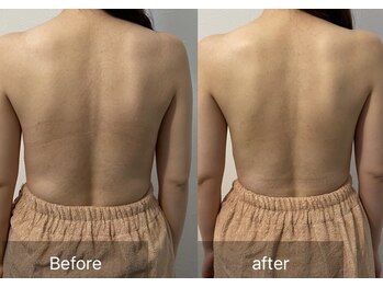 アウラ(Aula)/美背中トリートメント