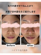 サロン ド ミコラ(salon de Micora)/次世代美容液毛穴洗浄！