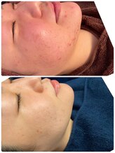 レイビューティサロン(Lei beauty salon)&nbsp;ハーブ ピーリング