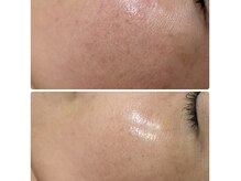 クラティス 伊那店(CRATIS)の雰囲気（お肌が変わるレチノール♪ニキビケア、ハリツヤUP、毛穴ケアに！）