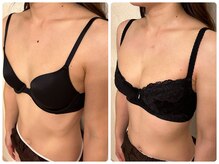 プリマ(prima)/バストアップ症例