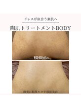 イルソーレ(IL Sole)/ニキビや沈着にハーブピーリング
