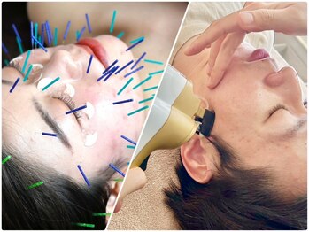サプル(supple)の写真/<ハリ&弾力が桁違い★衰え肌が覚醒◎>ゆるんだ肌もピタッと引き締まる♪【韓国式リジュラン×美容鍼】