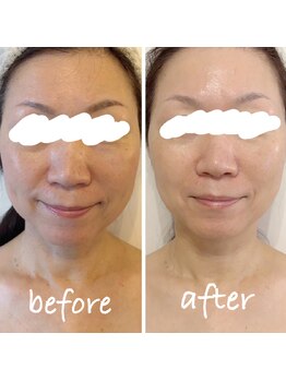 ルーシーガーデン(LUCY GARDEN)/50代女性/1回目◎肌色トーンUP