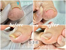 名古屋巻き爪専門Proの雰囲気(巻き爪、陥入爪も1回目から驚きの変化!)