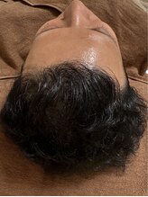 アマリージョヒラソル/Lit ヒト羊膜幹細胞