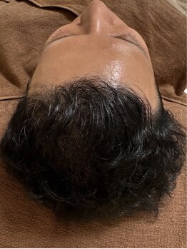 アマリージョヒラソル/Lit ヒト羊膜幹細胞