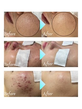 リノミラ(LINOMIRA)の写真/本気で美肌を目指す方に！ニキビ・毛穴悩みの方。美肌に特化した施術をご提供！的確な施術で結果重視。
