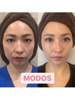 モドス(MODOS)/左：施術直後/右：２カ月後