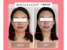 真美(Sinbi)/リターンフェイシャル施術2回