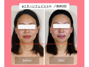真美(Sinbi)/リターンフェイシャル施術2回