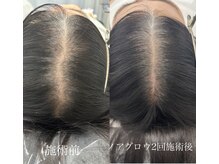 リアリア(LEALEA)/スカルプ