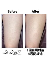 ルリアン(Le Lien)/【レディース】太もも症例