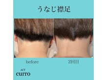アクト クロ(ACT curro)/【うなじ襟足】脱毛施術例
