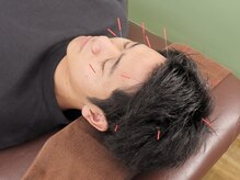 リボーン鍼灸整骨院(reborn鍼灸整骨院)/美容鍼