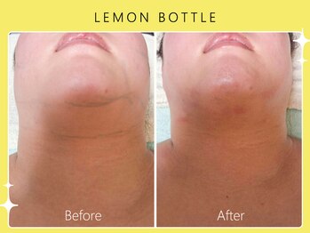 シロカネ イオンタウン西熊本店(SHIROKANE)/小顔コルギ×レモンボトル☆