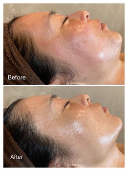 エステ シンセリティー(aesthetic sincerity)の写真/年齢と逆行できる美肌へ！毛穴・シミ・シワ・リフトアップでモチベーションアップ♪