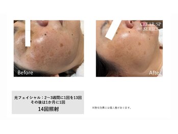 メルシートータルビューティー(MERCI)の写真/鏡ずっと見たい！シミケアで叶える、つるんとした透ける白肌へ導く特別なケア◎