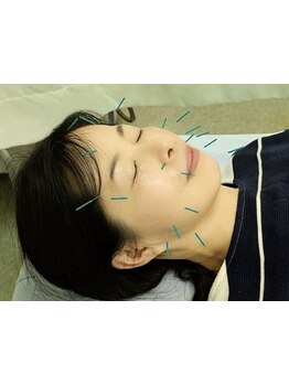 鍼灸施術を受けたい