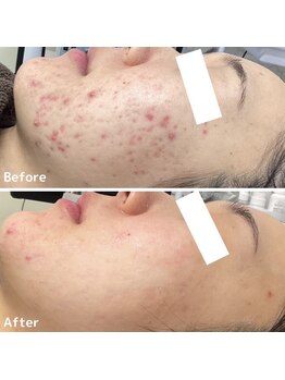 ニキビケア研究所 渋谷店/赤み肌・赤ニキビケア