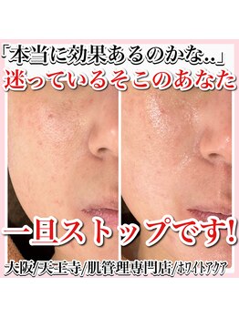 ホワイトアクア 天王寺本店(WHITE AQUA)/ハーブピーリング/大阪/天王寺