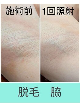 エミナル(EMINAL)/脇脱毛の効果!脱毛/全身脱毛/