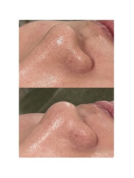 ビューティービューティー(beauty×beauty)/毛穴洗浄