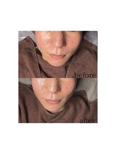 マリーメリー(marie merry)/艶肌wax＋プラズマシャワー