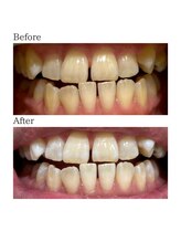 ノーブル 上土店(Noble)/ホワイトニングBeforeAfter