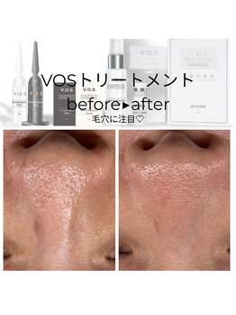 ロア ビューテ(loa beaut'e)/VOS　before→after