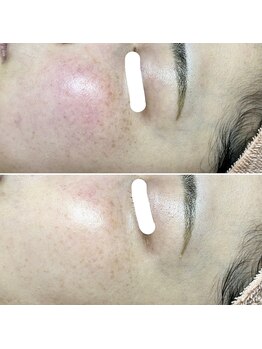 ルーチェエムベルシック(Luce.MBelChic)/敏感肌とシミのお悩み