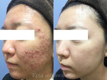 エピア 三河安城店(Epia)の雰囲気（学生の頃から繰り返すニキビケアはEpiaにお任せ下さい◎）