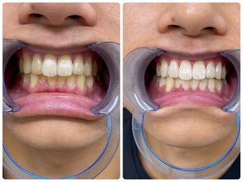 エクシアホワイトニング 日本橋店/ホワイトニング