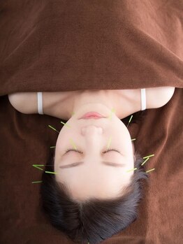 まつの鍼灸院の写真/【加古川・東加古川】 美容鍼でたるみ、ほうれい線を改善し、フェイスラインがスッキリ！