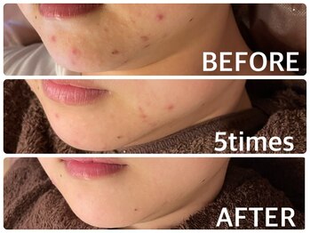 ハーブピーリング 恵比寿/顎ニキビ/くすみ/透明感